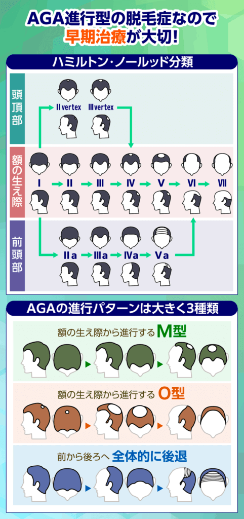 AGAの進行パターンに関する画像